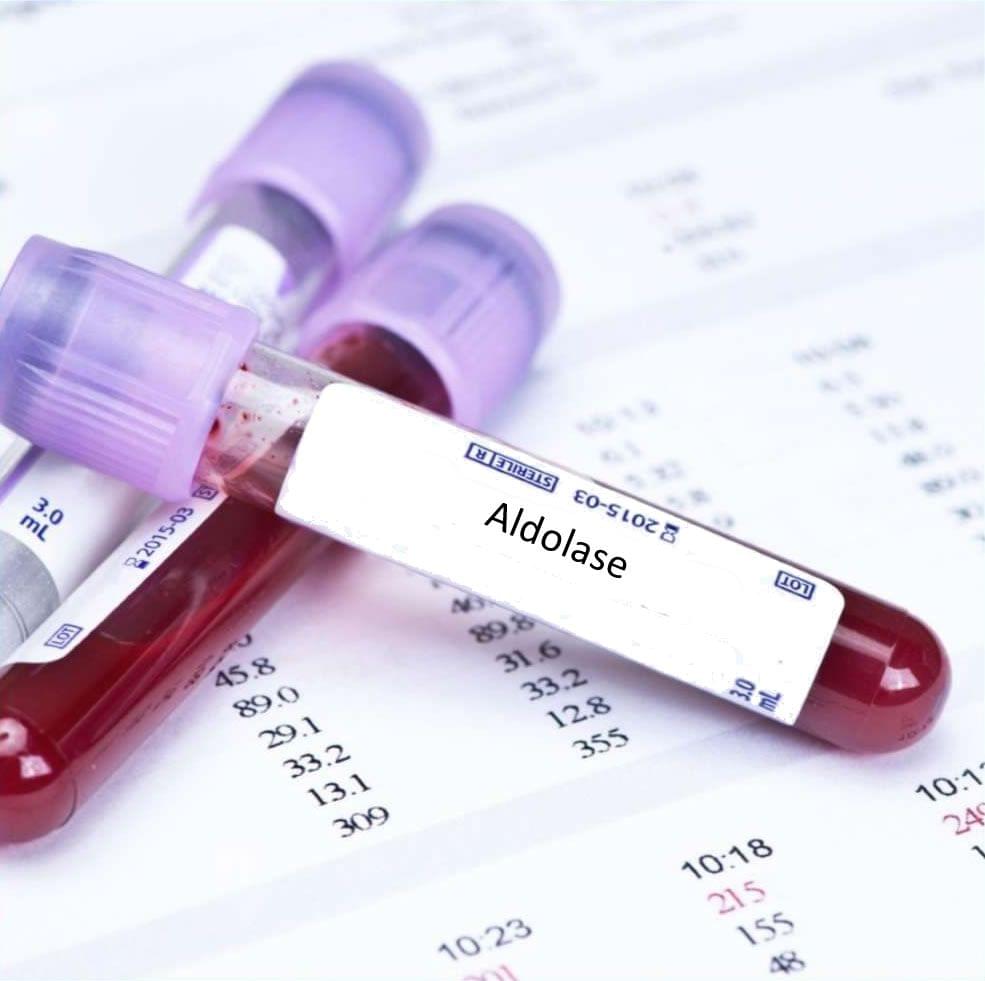 Aldolase Blood Test In London - Order Online Attend Clinic